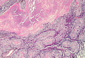 Chronic granulomatous disease, light micrograph