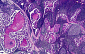 Adenocarcinoma of the lymph glands, light micrograph