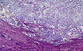 Bile duct cancer, light micrograph