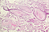 Basal cell carcinoma, light micrograph
