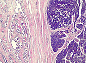 Prostate cancer, light micrograph