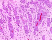 Diffuse large B-cell lymphoma AIDS-related, light micrograph