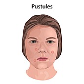 Pustules, illustration