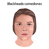 Blackhead comedones, illustration