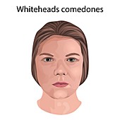 Whitehead comedones, illustration