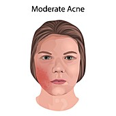Moderate acne, illustration