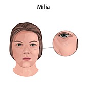 Milia, illustration