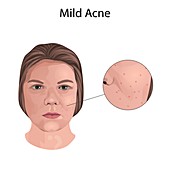Mild acne, illustration