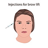 Injections for brow lift, illustration