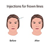 Injections for frown lines, illustration