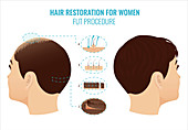 FUT hair loss treatment in women, illustration