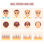 Male pattern hair loss, illustration
