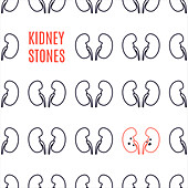 Kidney stone disease, illustration