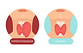 Healthy thyroid gland and hyperthyroidism, illustration