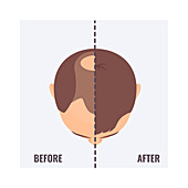 Man before and after hair transplant, illustration