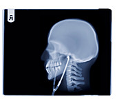 Skull with stethoscope, X-ray