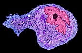 Bladder cancer cell, TEM