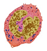 Sarcoma cancer cell, TEM