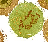 Carcinoma cell, TEM