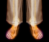 Lower legs in trousers, X-ray