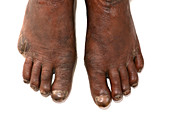 Feet affected by leprosy