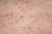 Atopic dermatitis