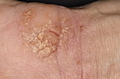 Eczema