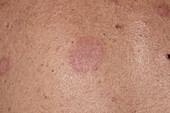 Discoid eczema