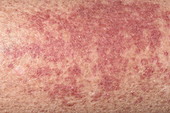 Allergic vasculitis