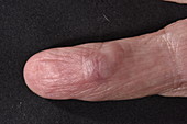 Bone tumour of the finger