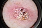 Keratoacanthoma, dermatoscope image