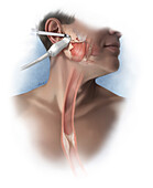 Botulinum Toxin for Side-Effect Management for Esophageal Cancer, Illustration