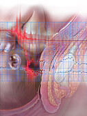 Amniotic Embolism, Illustration