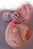 Hypertension in Pregnancy, Illustration