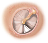 Tympanic Membrane, Illustration