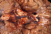 Human Brain, Subarachnoid Basal Hemorrhage