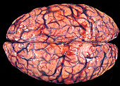Human Brain, Meningeal Congestion