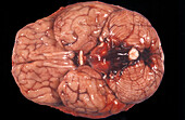 Human Brain, Subarachnoid Hemorrage