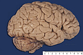 Human Brain, Cortical Atrophy