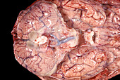 Human Brain, Meningitis