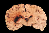 Human Brain, Hemorrhagic Infarct