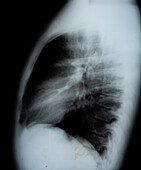 Chest X-ray, Lateral View
