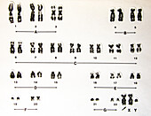 Human Male Karyotype with Extra X Chromosome