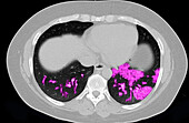 COVID-19 Lungs, CT Scan