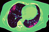 COVID-19 Lungs, CT Scan