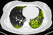 Lungs with Vaping Damage, Baseline CT