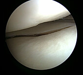 Arthroscopic knee surgery