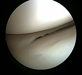 Arthroscopic knee surgery