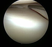 Arthroscopic knee surgery