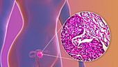 Uterine cancer, illustration and light micrograph